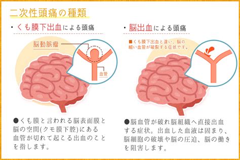 頭痛 原因|頭が痛いときに考えられる原因は？頭痛の種類と症状。